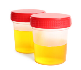 Containers with urine sample for analysis on white background