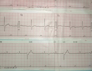 premature ventricular contraction or pvc or ventricular extra systole ves
