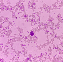 Chronic myeloid leukemia (CML) in accelerated phase also known as Chronic myelogenous leukemia....