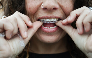 unrecognizable woman putting on an invisible tooth apparatus. aesthetic orthodontics