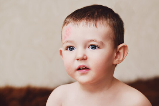 Toddler baby face with scratch on forehead. Portrait of a baby boy with a head injury. Kid aged one year six months