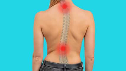 Woman with scoliosis of the spine. Curved woman's back. Severe pain in the cervical and lower thoracic or lumbar spine - obrazy, fototapety, plakaty