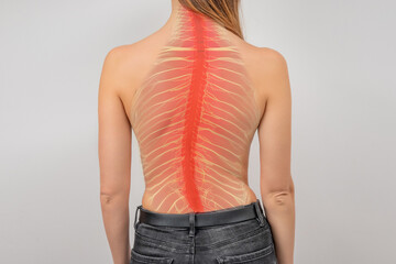 Woman with scoliosis of the spine. Curved woman's back. Terrible pain in the spine - obrazy, fototapety, plakaty