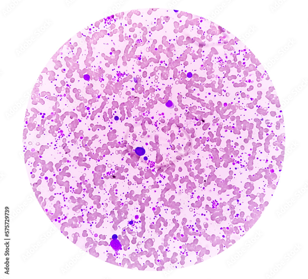 Poster chronic myeloid leukemia (cml) in accelerated phase with thrombocytosis. chronic myelogenous leukemi