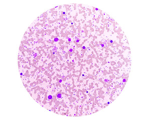 Chronic myeloid leukemia (CML) in accelerated phase with thrombocytosis. Chronic myelogenous...