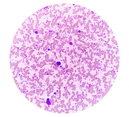 Chronic myeloid leukemia (CML) in accelerated phase with thrombocytosis. Chronic myelogenous leukemia.