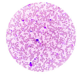 Chronic myeloid leukemia (CML) in accelerated phase with thrombocytosis. Chronic myelogenous...