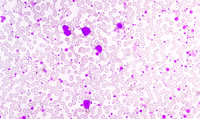 Chronic myeloid leukemia (CML) in accelerated phase with thrombocytosis. Chronic myelogenous leukemia.