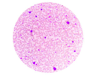 Chronic myeloid leukemia (CML) in accelerated phase with thrombocytosis. Chronic myelogenous leukemia.