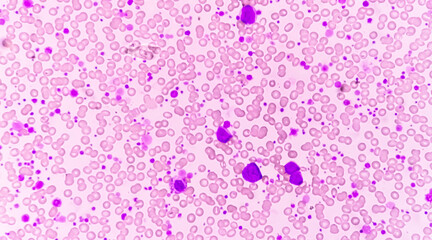 Chronic myeloid leukemia (CML) in accelerated phase with thrombocytosis. Chronic myelogenous leukemia.
