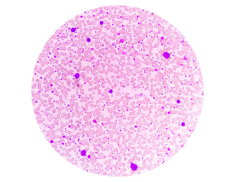 Chronic myeloid leukemia (CML) in accelerated phase with thrombocytosis. Chronic myelogenous leukemia.