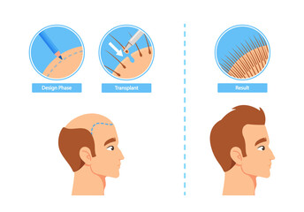 Fototapeta na wymiar Hair Transplantation Process Infographics Including Design Phase, Transplant and Result Stages. Before and After Images