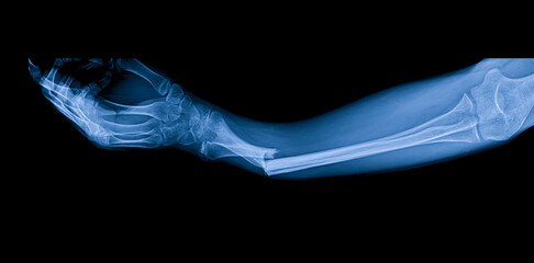 Blue tone radiograph on dark background in hospital.Doctor used xray for diagnosis.Forearm fracture...