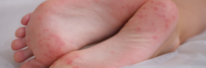 Fototapeta premium Children foot with dermatitis allergic rash closeup