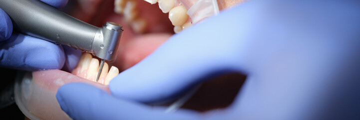 Dentist prepares woman teeth for the installation of ceramic veneers and crowns using drill