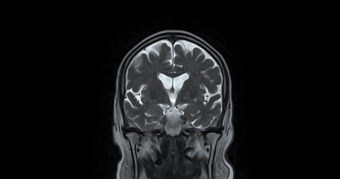 MRI Brain  can help doctors look for conditions such as bleeding, swelling, tumors, infections, inflammation, damage from an injury or a stroke diseases.