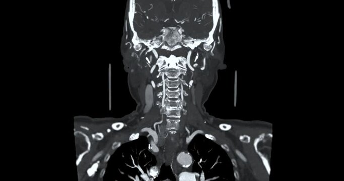 CTA Neck or Carotid artery Coronal view
