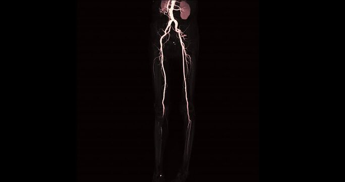 CTA femoral artery run off showing  femoral artery for diagnostic  Acute or Chronic Peripheral Arterial Disease.