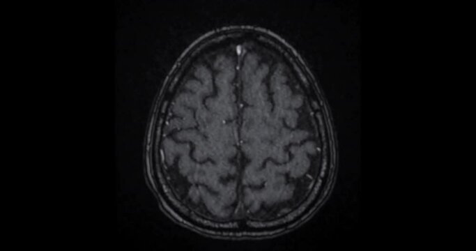 MRI Brain Axial TOF  can help doctors look for conditions such as bleeding, swelling, tumors, infections, inflammation, damage from an injury or a stroke diseases.