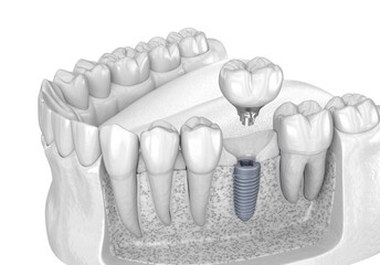 Dental crown installation over implant abutment. Medically accurate 3D illustration of human teeth and dentures concept