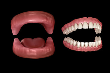 Maxillary and Mandibular prosthesis, artificial dentures. Medically accurate 3D illustration of human teeth and dentures