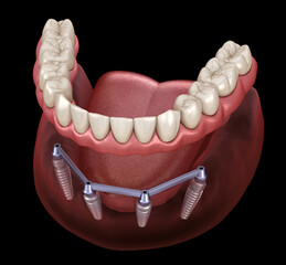 Fototapeta na wymiar Mandibular prosthesis with gum All on 4 system supported by implants. Medically accurate 3D illustration of human teeth and dentures concept