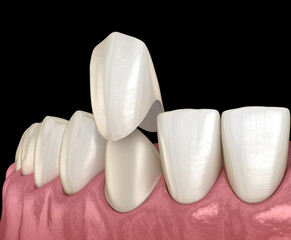 Veneer placement procedure. Medically accurate tooth 3D illustration