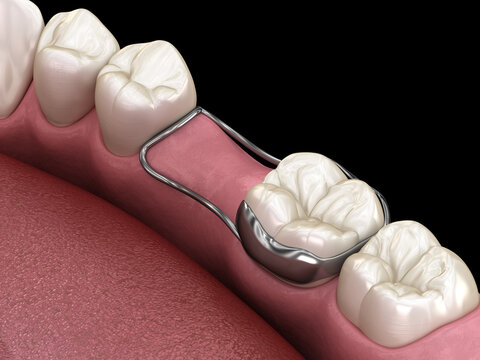 Space Maintainer Unilateral keeps from teeth shift deformatiuon after losing molar tooth. 3D illustration