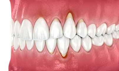 Gingiva recession. 3D illustration of Dental problem