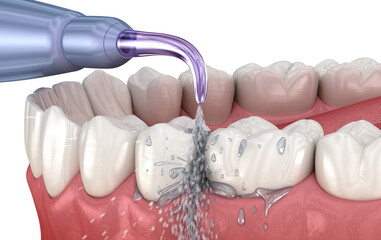 Dental Irrigator, Water teeth cleaning. Medically accurate 3D illustration of oral hygiene. - 575909559