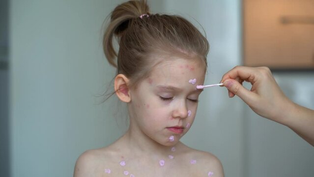 Mothers hands applies ointment on face of sick girl with chickenpox. Skin rash treatment
