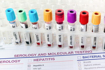 Laboratory tray with collection of blood testing sample tubes for Serology analysis. Rack of tubes with blood samples from patients in the Serology test lab