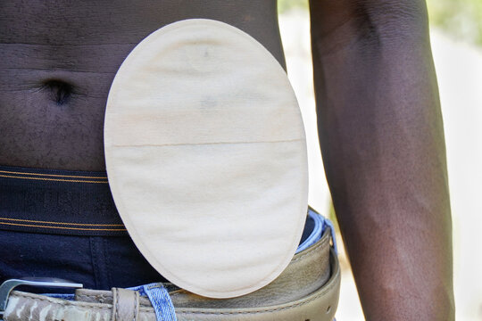 African person with a colostomy bag. Health care