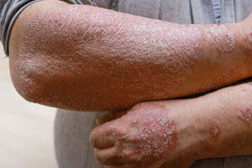 Psoriasis skin with red wounds. Male arms with cracked, hard, horny, flaky skin. Dermatological problems of allergy, eczema. Hand stains, rash, dry skin. The concept of chronic disease treatment
