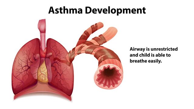 Animation of Asthma Development with Explanation