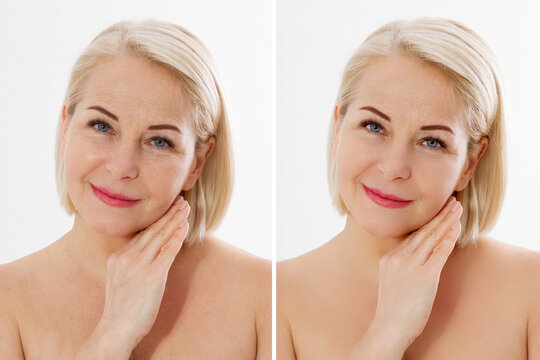 Closeup before after Beauty middle age woman face portrait. Before-after Spa anti wrinkled aging female body parts concept. Mid-aged Plastic surgery collagen face injections. Beauty Wrinkles menopause