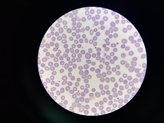 Abnormal red blood cells morphology macrocyte.