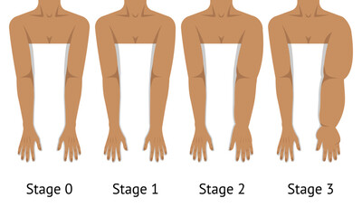 Women's arms in different stages of Lymphedema - 576302995