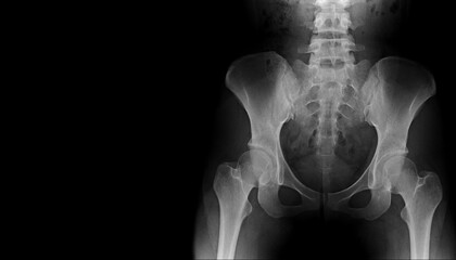 Film x-ray of human pelvis and hip joints