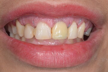 Frontal view of a woman mouth smiling with fake teeth of porcelain fixed prosthetic dental crown in central incisor  and gingiva surgery and surgical suture thread.