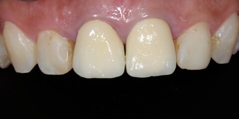 Frontal view of maxillary arch incisor and canine teeth and fixed prosthetic dental crowns in central incisors. Black background with dental photography contraster. © MSC
