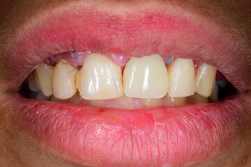 Frontal view of a woman mouth smiling with fake teeth of porcelain fixed prosthetic dental crown in...