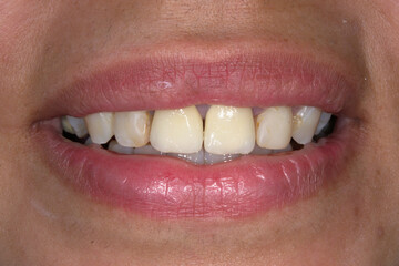 Frontal view of a woman mouth smiling with fake teeth fixed prosthetic dental crowns in central incisors.