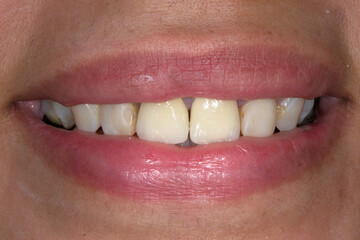 Frontal view of a woman mouth smiling with fake teeth fixed prosthetic dental crowns in central incisors.