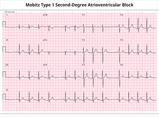 Mobitz Type 1 Second Degree Atrioventricular Block - ECG Paper 12 Lead - Electrocardiogram - Vector Medical Illustration - obrazy, fototapety, plakaty