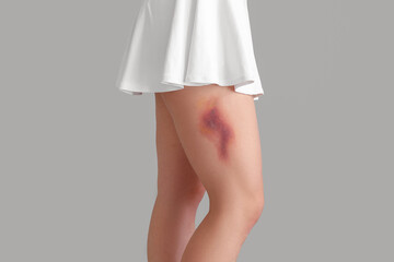 Young woman with bruised leg on grey background