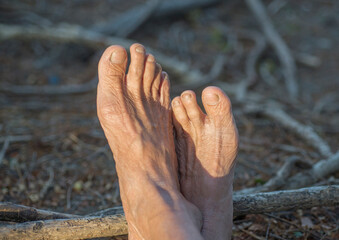 The feet of the elderly who suffer from dry and shriveled skin and nail fungus.