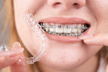 Dental care.Smiling girl with braces on her teeth holds aligners in her hands and shows the difference between them