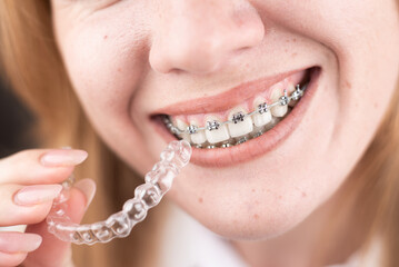 Dental care.Smiling girl with braces on her teeth holds aligners in her hands and shows the...