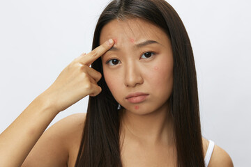 Asian woman facial skin problems, acne and inflammation, red rashes and allergies, chicken pox,...